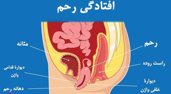 عکس واژن بعد از زایمان طبیعی نی نی سایت