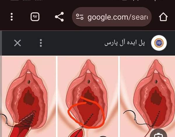 عکس بخیه واژن بعد از زایمان طبیعی نی نی سایت