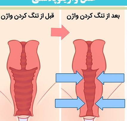 عکس بخیه واژن بعد از زایمان طبیعی نی نی سایت