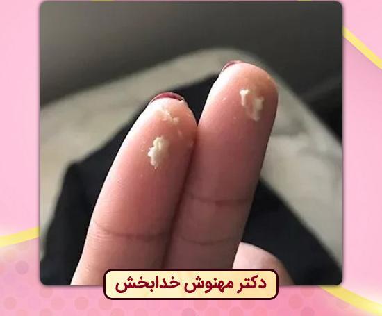 قارچی عکس ترشحات پنیری واژن نی نی سایت