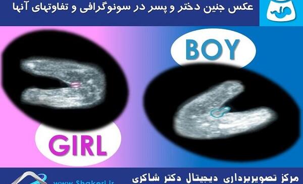عکس سونو غربالگری اول نی نی سایت