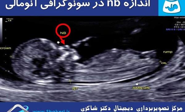 عکس سونو غربالگری اول نی نی سایت