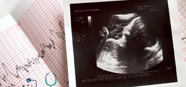 عکس آزمایش غربالگری اول نی نی سایت