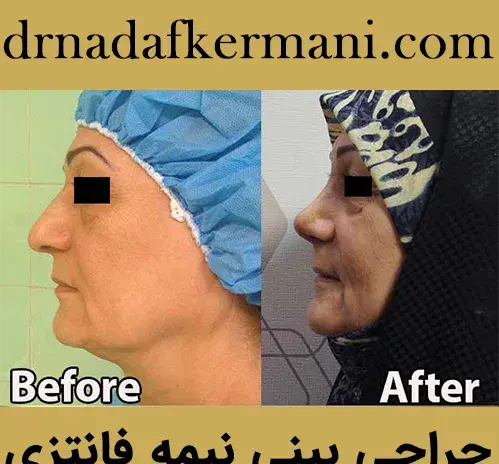 عکس عمل بینی طبیعی نی نی سایت