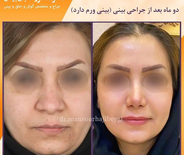 عکس عمل بینی طبیعی نی نی سایت