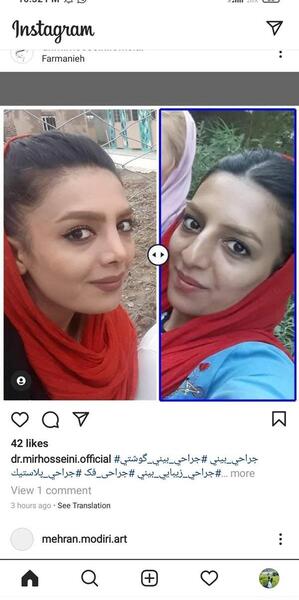 عکس عمل بینی طبیعی نی نی سایت