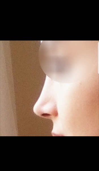 عکس عمل بینی طبیعی نی نی سایت