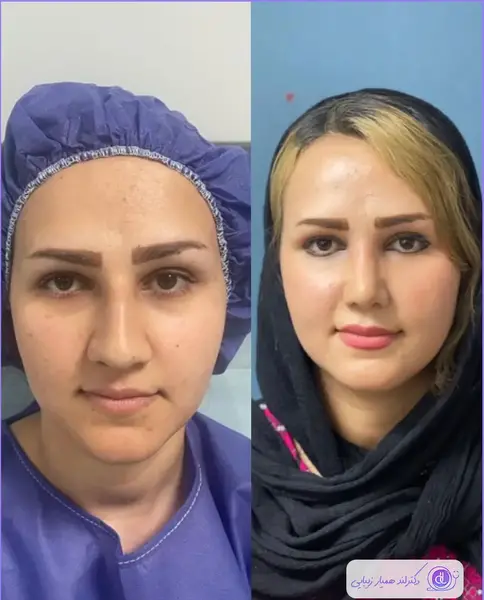 عکس عمل بینی طبیعی نی نی سایت