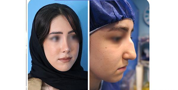 هزینه عکس عمل بینی نی نی سایت
