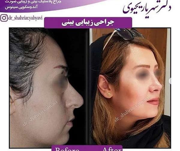 هزینه عکس عمل بینی نی نی سایت