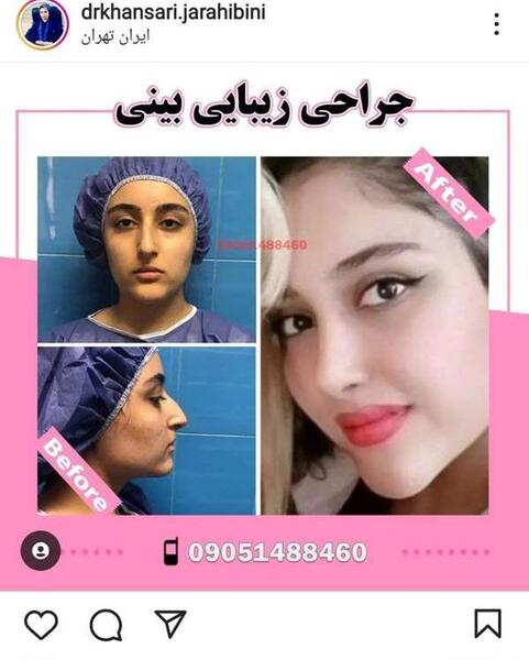 هزینه عکس عمل بینی نی نی سایت