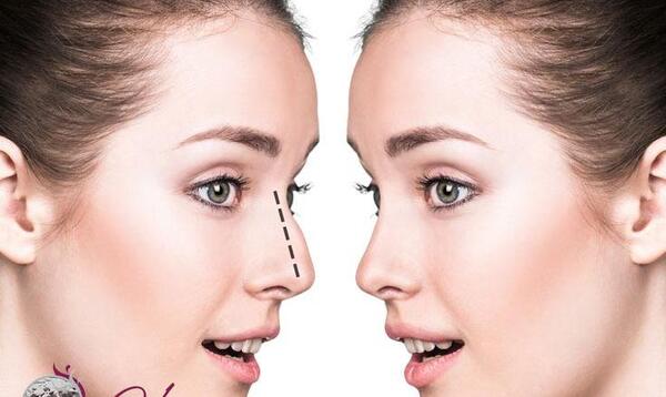 هزینه عکس عمل بینی نی نی سایت