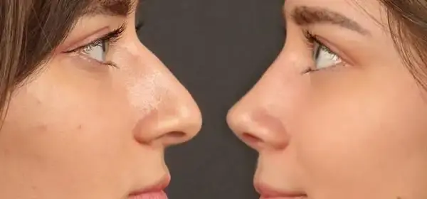 هزینه عکس عمل بینی نی نی سایت