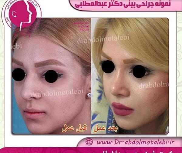 هزینه عکس عمل بینی نی نی سایت