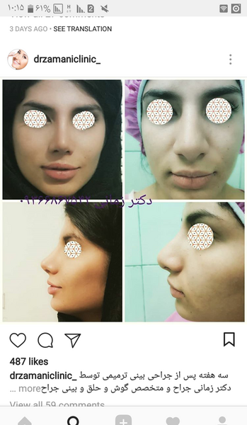 هزینه عکس عمل بینی نی نی سایت