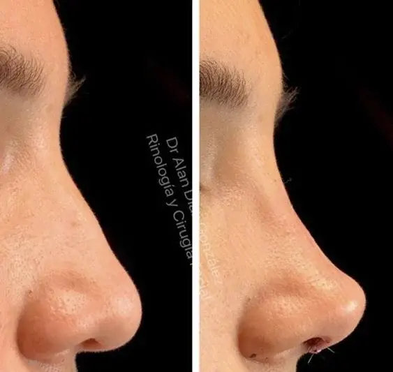 هزینه عکس عمل بینی نی نی سایت