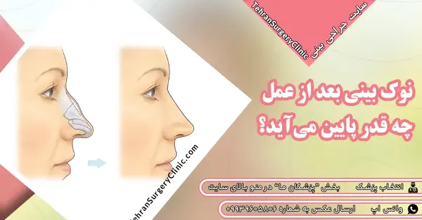 عکس قبل از عمل بینی نی نی سایت