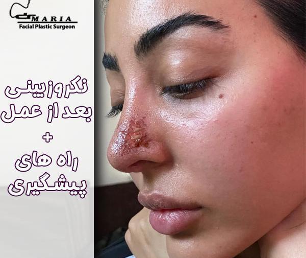 عکس قبل از عمل بینی نی نی سایت