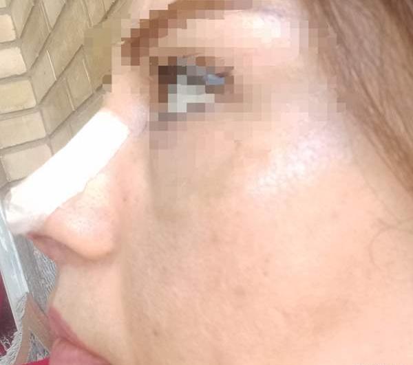 عکس قبل از عمل بینی نی نی سایت