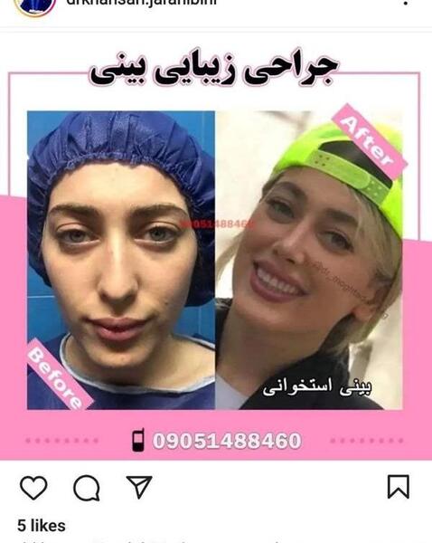 عکس قبل از عمل بینی نی نی سایت