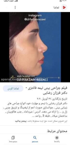 عکس قبل از عمل بینی نی نی سایت