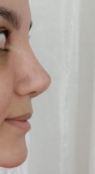 عکس بعد از عمل بینی نی نی سایت