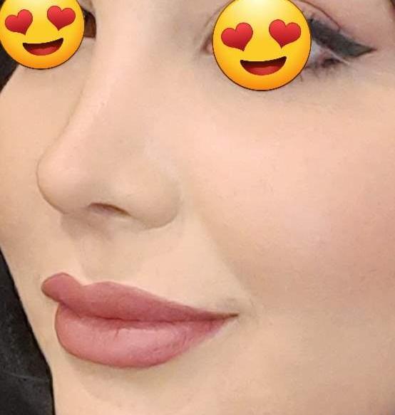 عکس بعد از عمل بینی نی نی سایت