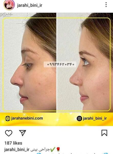 عکس بعد از عمل بینی نی نی سایت