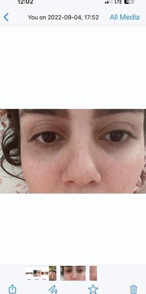 عکس بعد از عمل بینی نی نی سایت