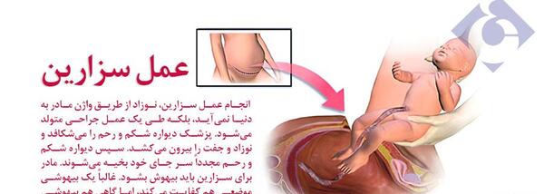 سزارین عکس شکمتون نی نی سایت
