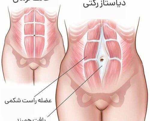 عکس شکم بعد از سزارین نی نی سایت