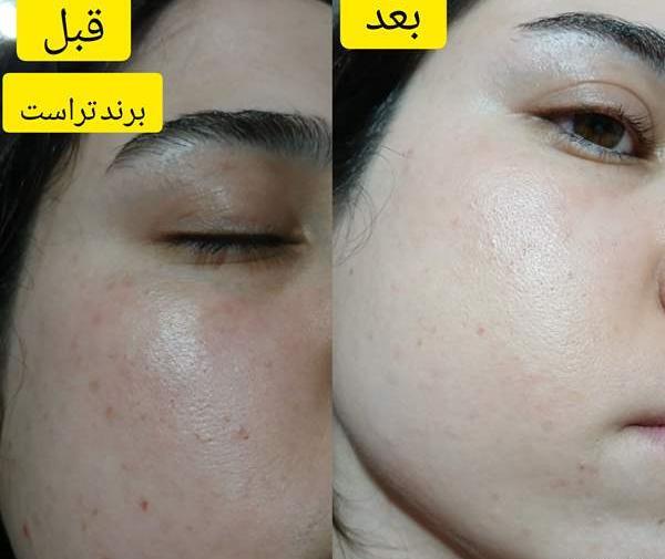 عکس فیشیال صورت نی نی سایت