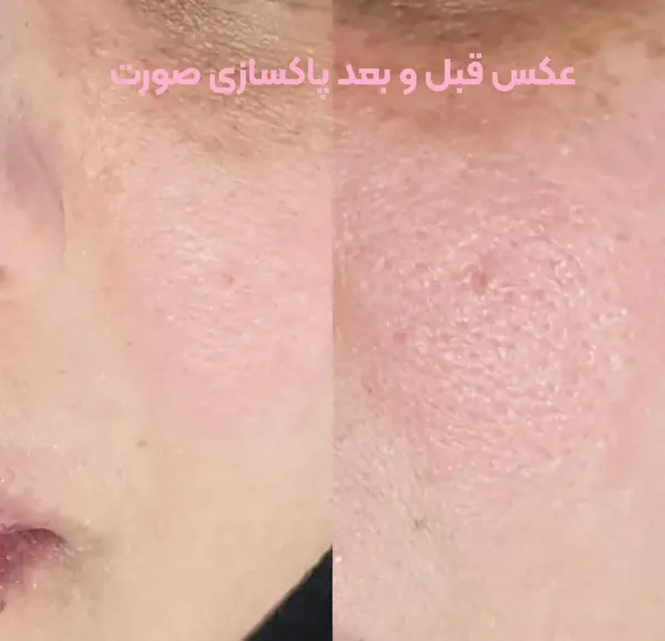 عکس فیشیال صورت نی نی سایت