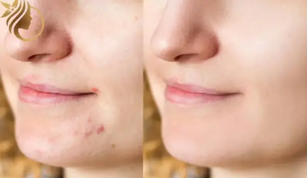 عکس فیشیال صورت نی نی سایت