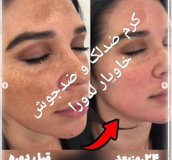 عکس فیشیال صورت نی نی سایت
