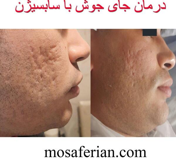 عکس فیشیال صورت نی نی سایت