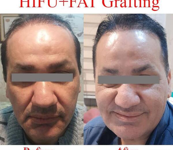 عکس تزریق چربی به صورت نی نی سایت
