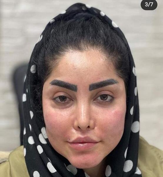 عکس تزریق چربی به صورت نی نی سایت