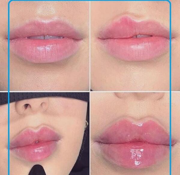 عکس تزریق چربی به صورت نی نی سایت