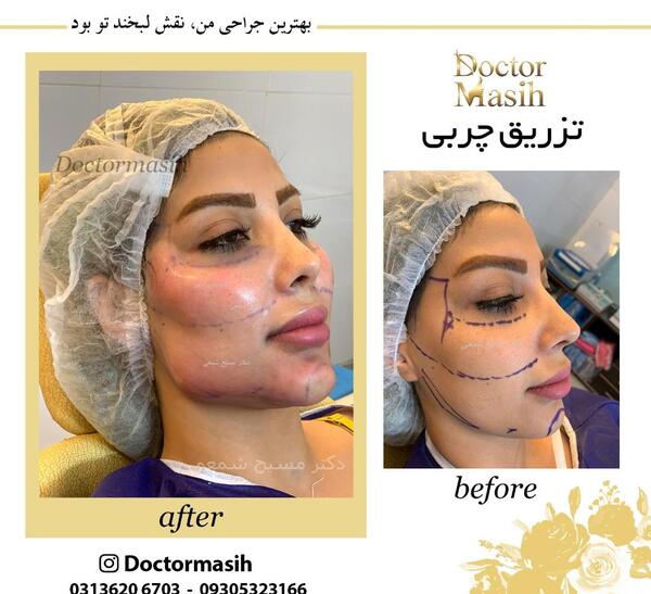 عکس تزریق چربی به صورت نی نی سایت