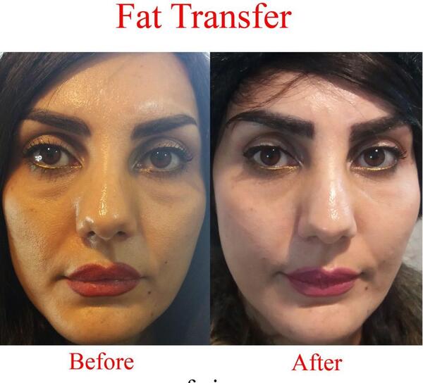 عکس تزریق چربی به صورت نی نی سایت