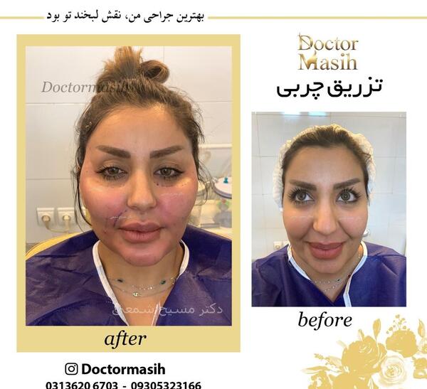 عکس تزریق چربی به صورت نی نی سایت