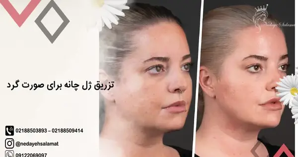 عکس تزریق چربی به صورت نی نی سایت