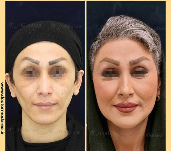 عکس تزریق چربی به صورت نی نی سایت