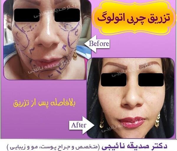 عکس تزریق چربی به صورت نی نی سایت