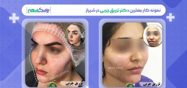 عکس تزریق چربی به صورت نی نی سایت