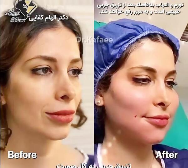 عکس تزریق چربی به صورت نی نی سایت