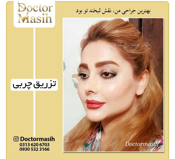 عکس تزریق چربی به صورت نی نی سایت