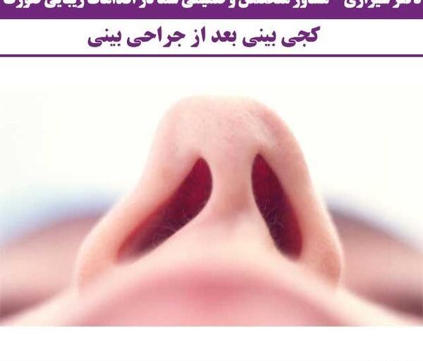 چرا تو عکس صورتم کج میشه نی نی سایت
