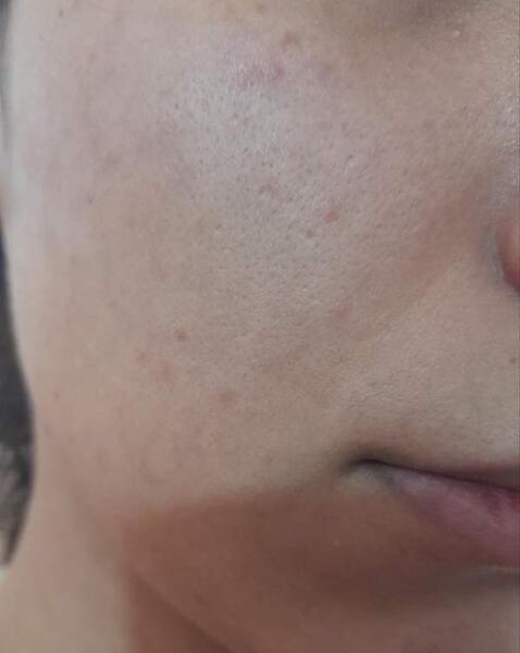 عکس صورت بعد از مزونیدلینگ نی نی سایت